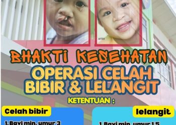 Sambut Hari Bhayangkara ke-80, Polda Jateng Gelar Operasi Gratis Celah Bibir dan Lelangit di RS Bhayangkara Semarang
