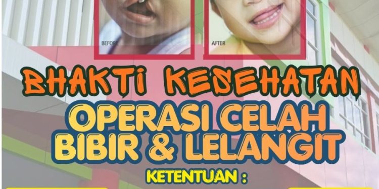 Sambut Hari Bhayangkara ke-80, Polda Jateng Gelar Operasi Gratis Celah Bibir dan Lelangit di RS Bhayangkara Semarang